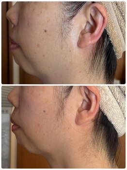 ジフィー(Gify)/顎すっきり!3Dフェイスへ