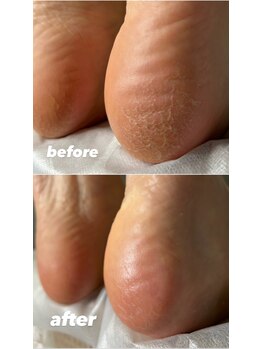 ビンナ 五反田店(Binna)/足裏角質ケア