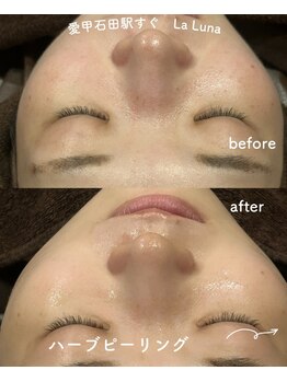 ラルーナ(LA LUNA)/ハーブピーリング