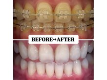 ホワイトニングサロン 豊中/Before&After美白ホワイトニング