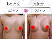 メディカルサロン エム エム エム 銀座プレミアムサロン(M.M.M.)/【バストアップ例】 C→Fカップ