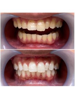 ホワイトニングサロン 名古屋駅店/【ホワイトニング施術例】