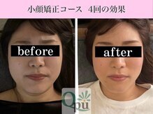 キュープ 福岡九大学研都市店(Qpu)/小顔矯正４回のコース