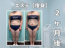 エックス(X)/【痩身】痩せたい部分を集中施術