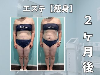 エックス(X)/【痩身】痩せたい部分を集中施術