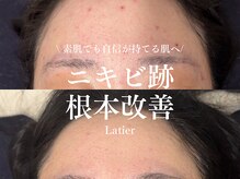 ラティエ(Latier)/ハーブピーリング1回の効果♪