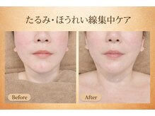 ラシクビューティールーム/食いしばり/小顔/リフトアップ