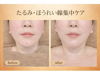 ラシクビューティールーム/食いしばり/小顔/リフトアップ