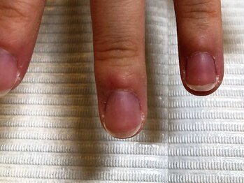 ネイルサロンアンドスクール シーグリーン(SEAGREEN)/【お悩み】乾燥による小ヅメ