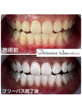 ホワイトニングサロン 京都烏丸店/ホワイトニング施術例