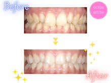 エクシアホワイトニング 札幌大通店/ホワイトニングビフォーアフター
