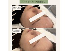 ライム(LIME)/ハーブピーリング【ソフト】