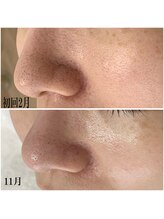 プラセル(Placer)/年齢肌のお悩【毛穴/黒ずみ】