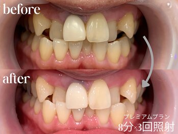 ホワイトニングカフェ 仙台八幡店/☆短期間で白さを求める方必見