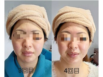 リノブルーム(LINO Bloom)/毛穴洗浄