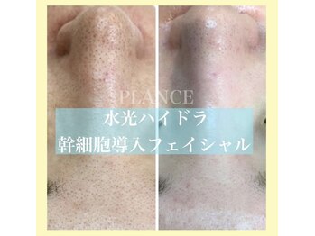 プランス 渋谷(PLANCE)/水光ハイドラフェイシャル渋谷