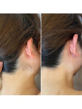 インベスト(INVEST)/うなじ脱毛