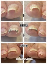 ジャミーラ(Jamila)/巻き爪矯正