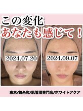 ホワイトアクア 錦糸町店(WHITE AQUA)/ハーブピーリング/東京/錦糸町