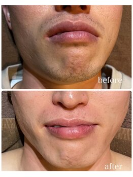 ルタンリッシュオム(Lutan Riche hom)/脱毛とフェイシャルダブルで!