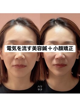 ハリサク/初回施術