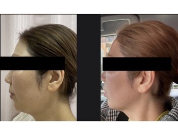 アイリー(IRIE)/インモード　ワンセラ