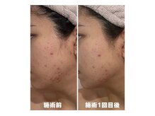バルディーナ(BALDINA)の雰囲気（【当店人気No．1】陶肌トリートメント1回目のBefore/After）