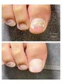 イオネイル(io nail)&nbsp;突然の爪のアクシデントも。
