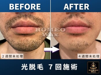 ロミオワックス 渋谷店(ROMEO Wax)/髭剃り毎日が月1に!!4週間未処理