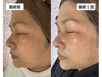 エトワール(etoile)/【肌トーンUP!若々しい美肌に】