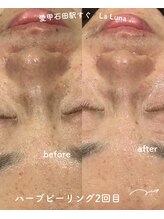 ラルーナ(LA LUNA)/ハーブピーリング