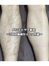 ディアー 原宿(Diar)/脚脱毛　ビフォーアフター