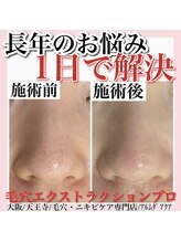 アルムダアクア 天王寺店(Aleumda AQUA)/毛穴エクストラクションプロ大阪