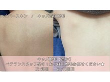 オーシャンブルー 時津店(OCEAN BLUE)/キッズ脱毛《背中》