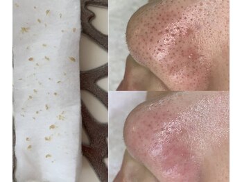 トトサロン(toto salon)/穴が開いてる…？それは開き毛穴