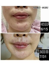 ノリスズ(NORI SUZU)/エクソソーム配合ヒト幹細胞導入