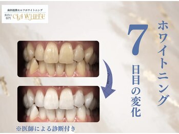 シアホワイト(CIA WHITE)/劇的ビフォーアフター