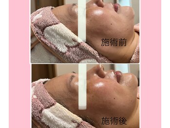 ローズ 下松(ROSE)/☆60代ハリのある肌☆再び☆