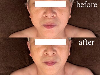 フウ(fuu.)/小顔カッサ