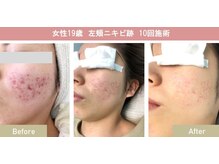 シャイン(SHINE)/