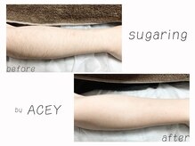 エイシー(ACEY)/ビフォーアフター☆腕