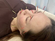 加島鍼灸接骨院/【ハリウッド式美容鍼】