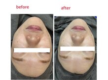 サロンドティアラ(Salon de Tiara)/シミケア(フォト)