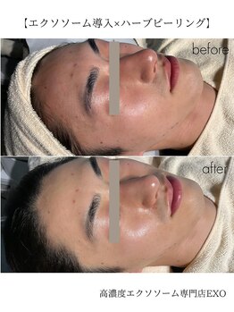エクソ 吉祥寺(EXO)/エクソソーム×ハーブピーリング