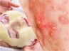 【肌質改善パーフェクトコース!オーナー自ら実証】ニキビケア+毛穴+赤ら顔+腸