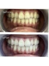 エクシアホワイトニング 津駅前店/お客様ビフォーアフター