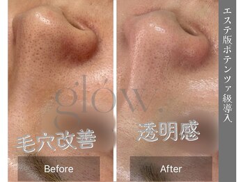 グロウ(glow.)/万能施術！毛穴改善も透明感も◎