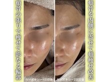 ハニエル(Haniel)/カーボキシー症例