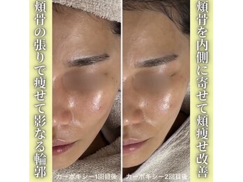 ハニエル(Haniel)/カーボキシー症例