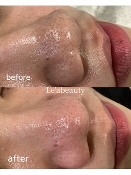 レアビューティー(Le'a beauty)の写真/《毛穴の開き・黒ずみでお悩みの方》毛穴の奥の汚れを除去し、透明感のあるお肌にトーンアップしませんか？